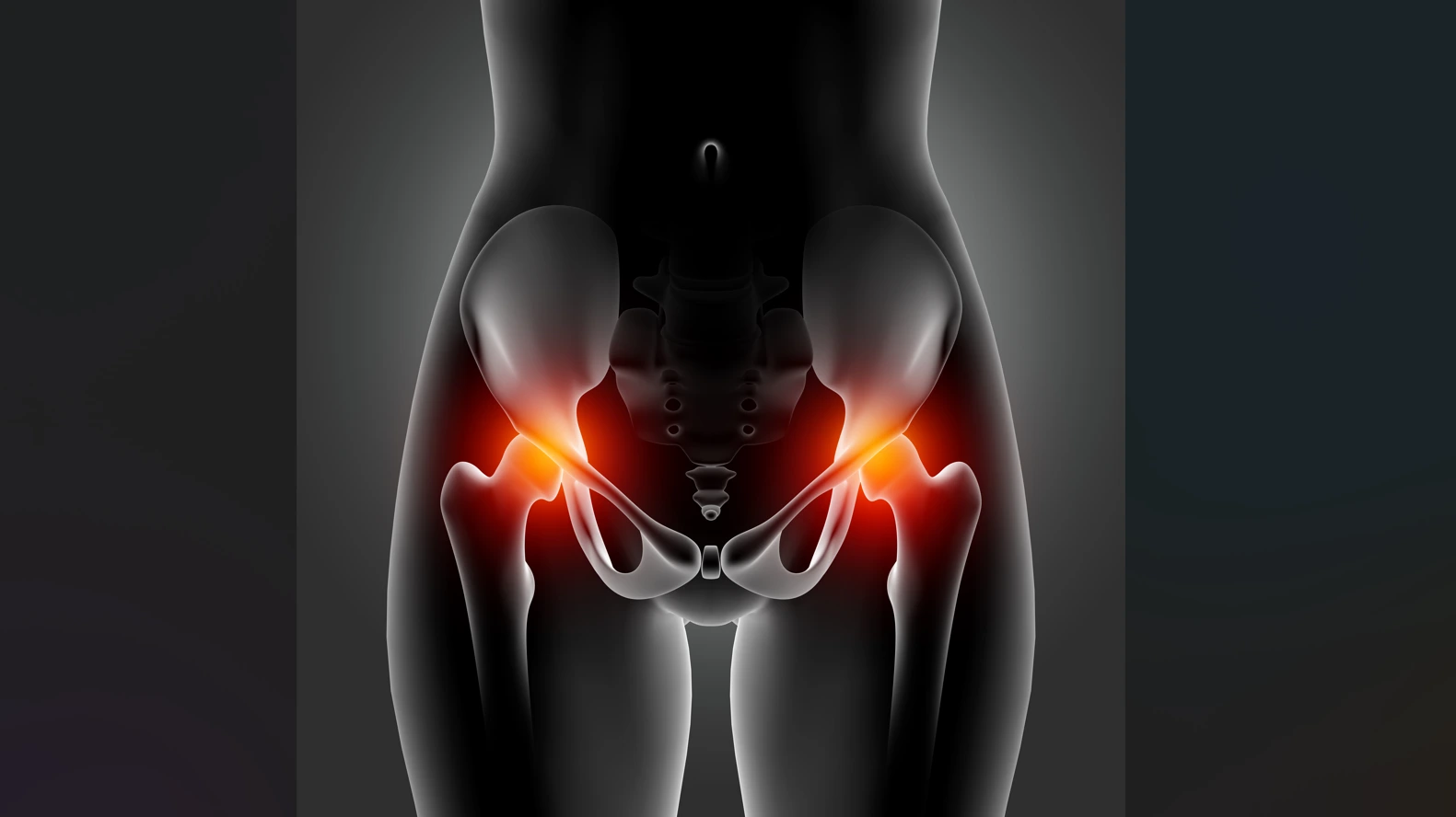 Revision Hip Replacement